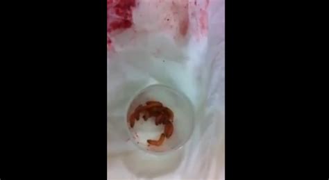 maggots in vagina|What Is It, Causes, Signs and Symptoms, and More.